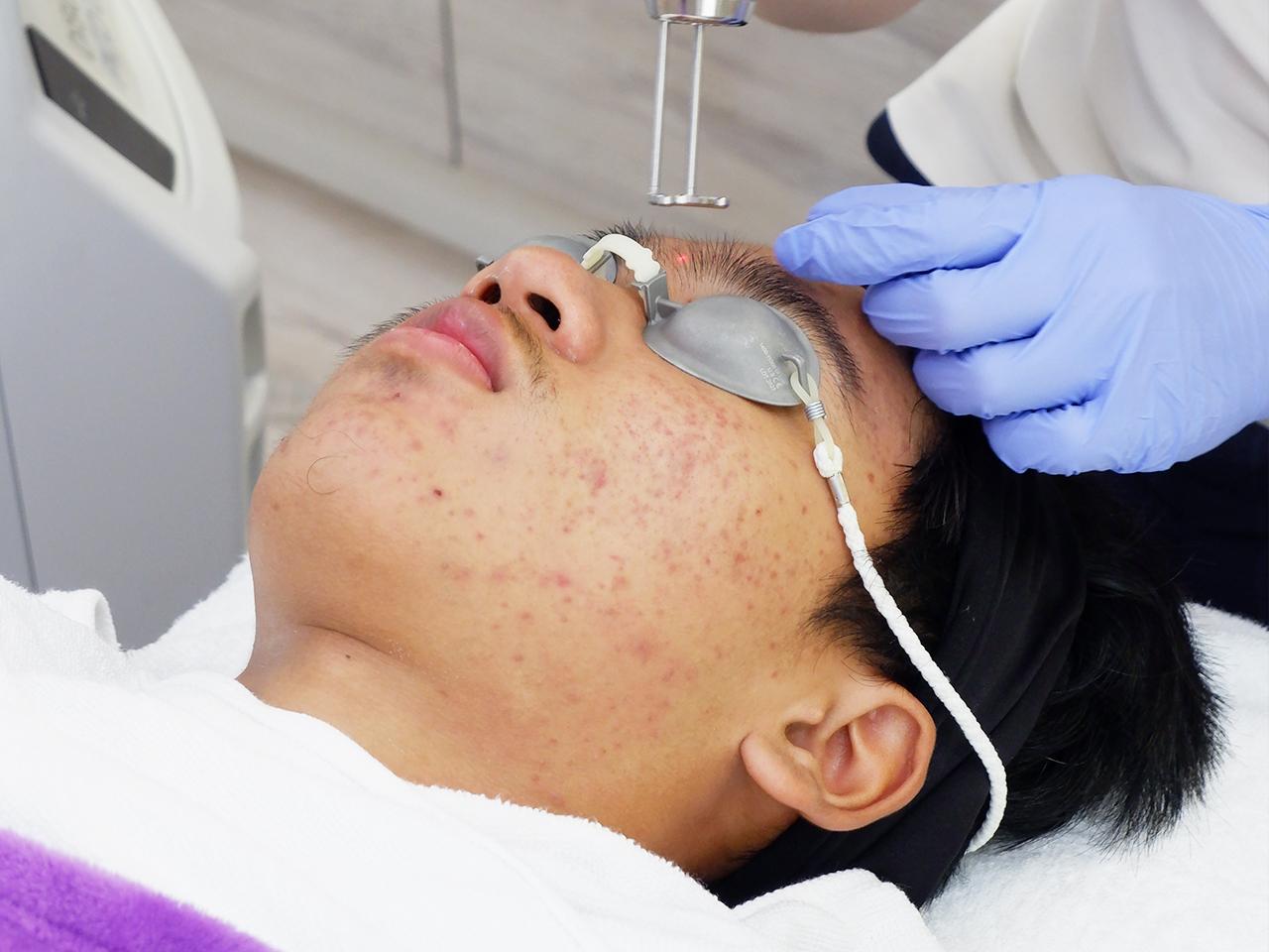 ภาพประกอบ Acne treatment program