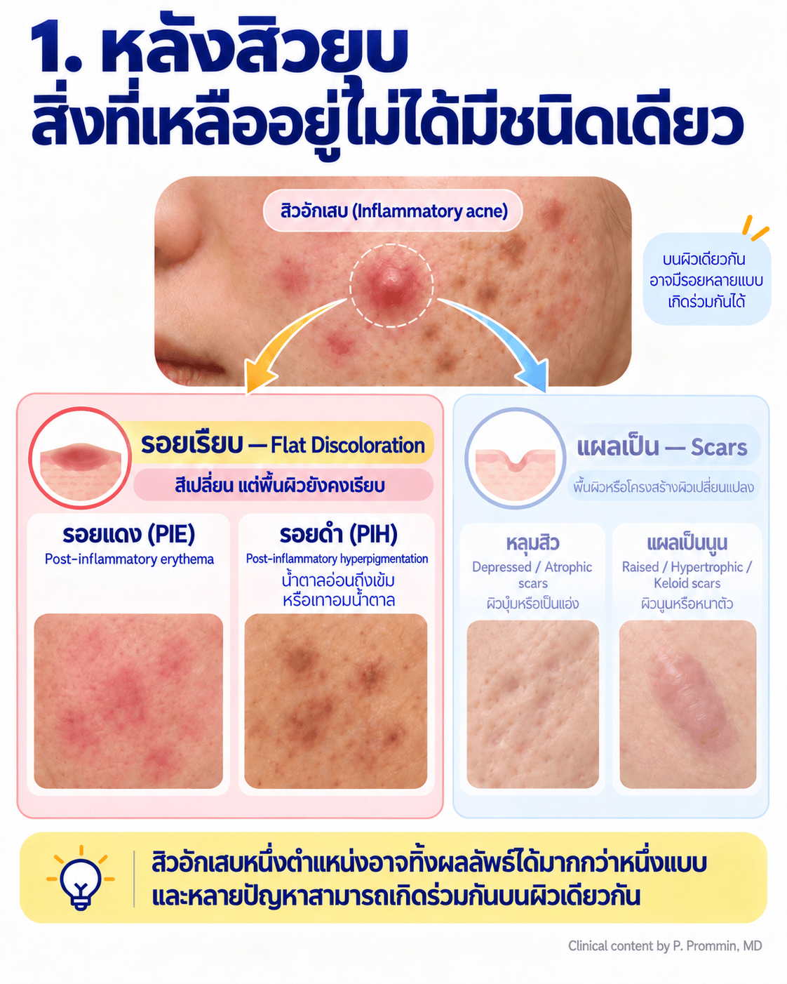 เข้าใจชนิดของรอยสิว และวิธีรักษาอย่างตรงจุด
